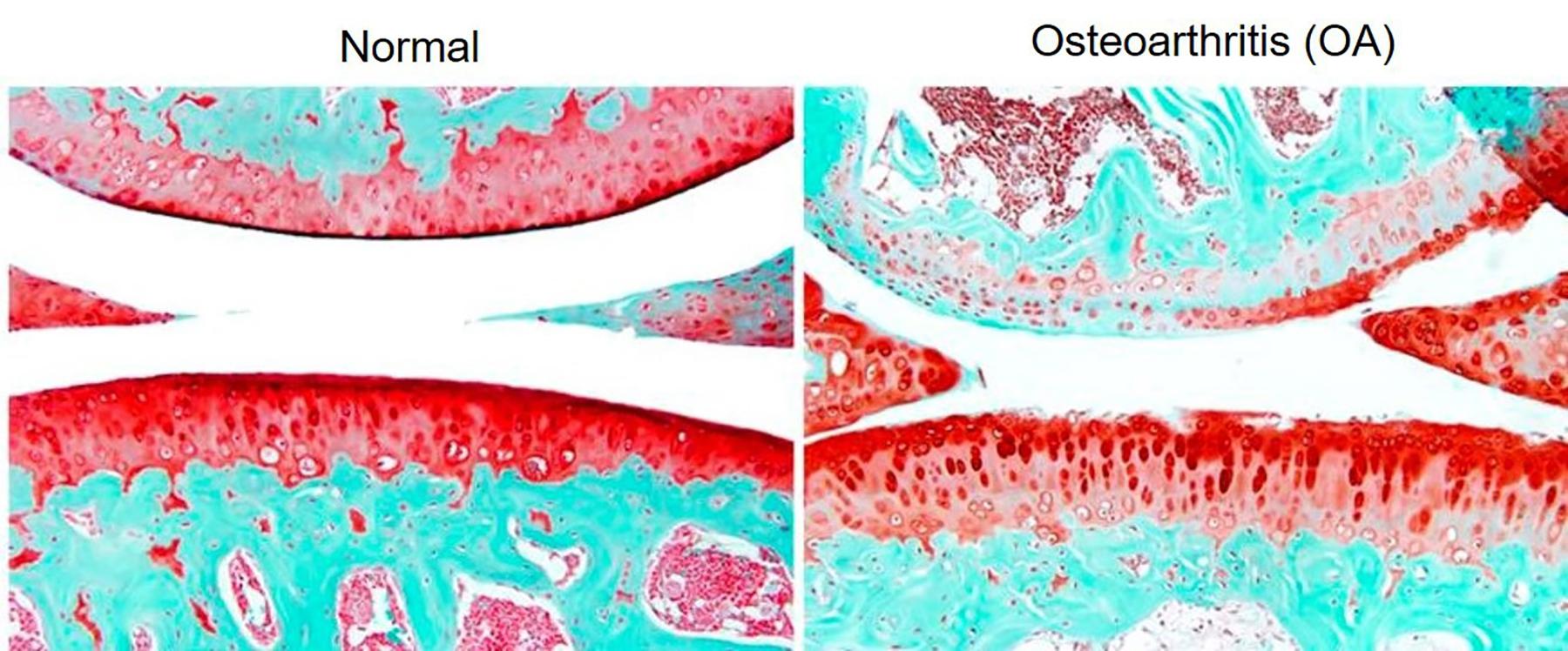 osteoarthritis research paper conclusion